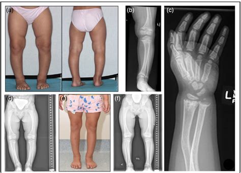 Mater Online Hypophosphataemic Rickets A Case Study Presented By Dr
