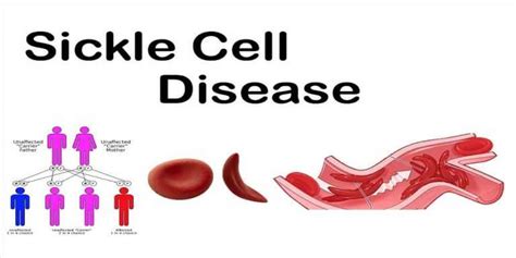 Sickle Cell Anemia Pain