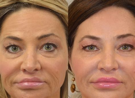 Face Lifting Non Surgical Ways Heta Skin Hair Laser And Cosmetic Clinic