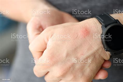 Closeup Of Red Spot On Skin Of Man Hand Stock Photo Download Image