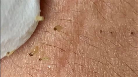Pimple Popping 2020 Super Blackheads Extraction Blackheads Removal