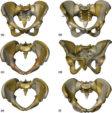Asymmetry Of The Pelvic Ring Evaluated By Ct‐based 3d Statistical