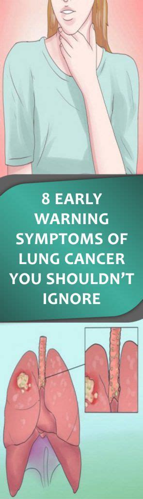 The symptoms of lung cancer can be divided into three main types: 8 EARLY WARNING SYMPTOMS OF LUNG CANCER YOU SHOULDN't IGNORE