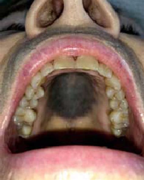 A Large Grayblue Macule On The Hard Palate As An Adverse Effect Of