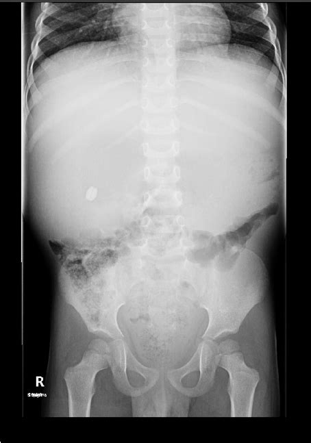 X Ray Abdomen That Shows Hugely Distended Stomach With A Radio Opaque
