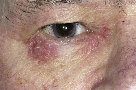 Eczema Around The Eye Stock Image M1500358 Science Photo Library