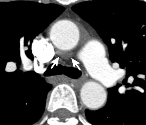 Ct And Mr Imaging Of Pericardial Disease Radiographics