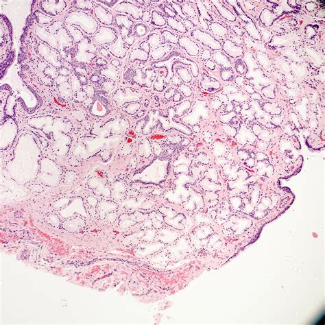 Pathology Outlines Vulvovaginal Cysts