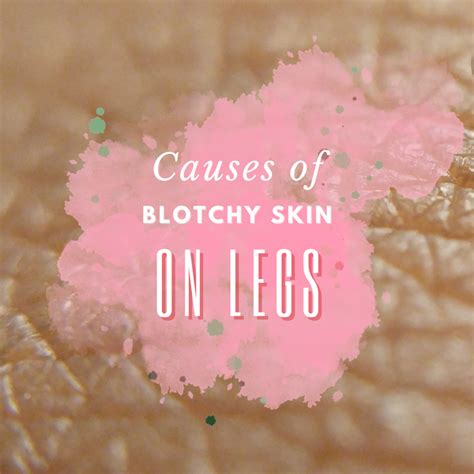 Blotchy Skin On Your Legs Can Be Embarrassing And Itchy Find Out What