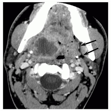 Deep Neck Infections Ento Key