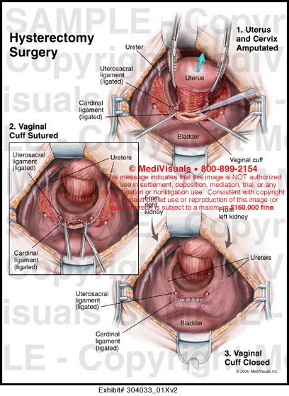 Hysterectomy Surgery Medical Illustration Medivisuals