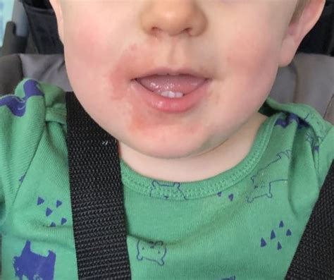 Rash Around Toddlers Mouth Babycenter