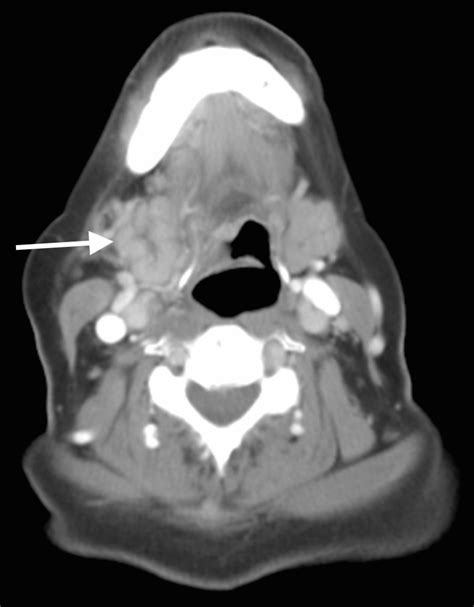 Cureus Utility Of Point Of Care Ultrasound For The Rapid Evaluation