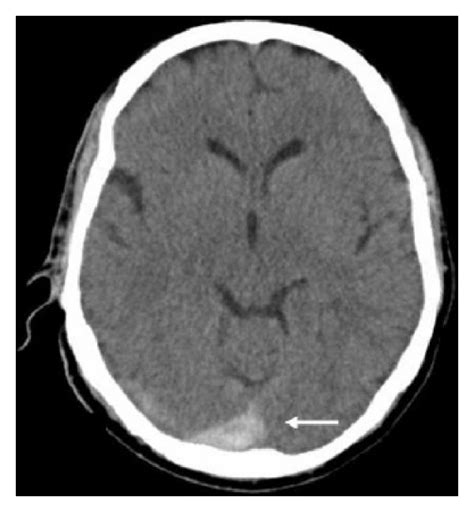 Second Ct Scan Brain Without Contrast Showing Clearly Visible