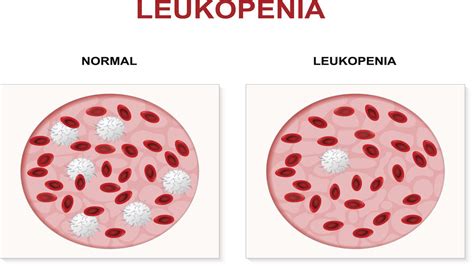 Symptoms And Treatment Of Leukopenia Health Hearty