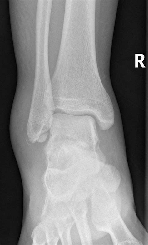 Lateral Malleolus Fracture