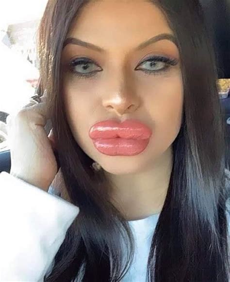 Fake Lips Big Lips Lip Plumper Plumping Beautiful Lips Beautiful Women Facial Surgery Lip