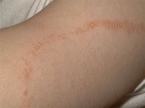 Itchy Lines On Skin Pictures Photos