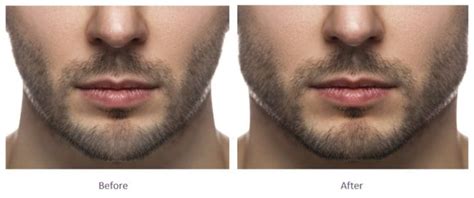 Jawline Fillers Before And After Jawline Fillers London