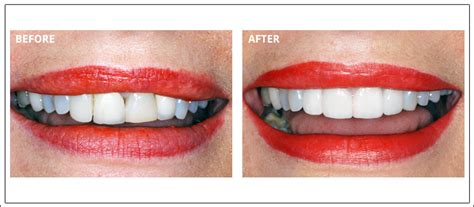 Smile Makeover In Mississauga Dentistry By Dr Sferlazza