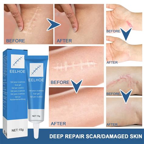 Scar Removal Cream Body Scar Gel Stretch Marks Surgery Injuries Burns