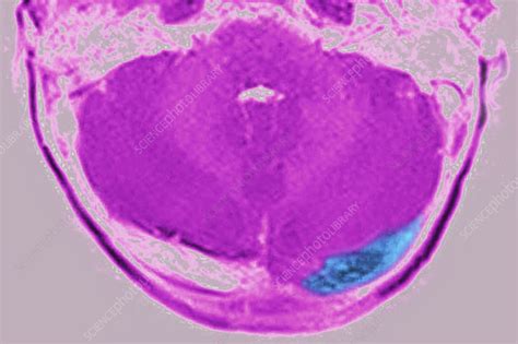 Cerebral Venous Thrombosis Mri Scan Stock Image C0556109
