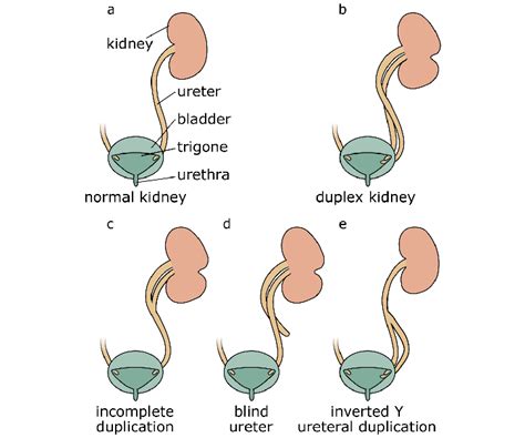 Classification Of Duplex Kidney Anatomy Compared With A Normal Kidney