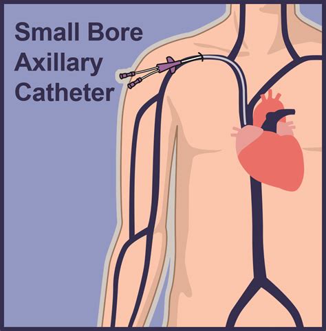 Central Venous Catheter Lines Vascular Wellness