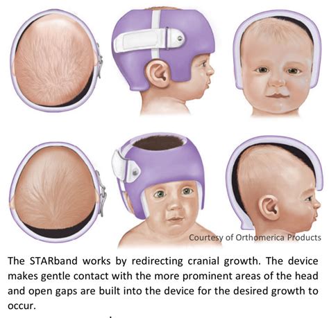 Cranial Remolding Del Bianco