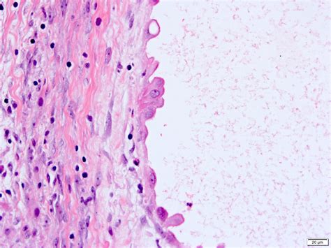 Pathology Outlines Adult Cystic Nephroma