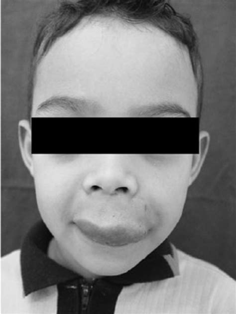 Preoperative Frontal Views Of The Patient At The Age Of 4 With A Large