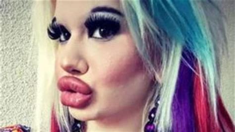 Bulgarian Woman Has Acid Injected Into Her Lips To Look Like Her Idol