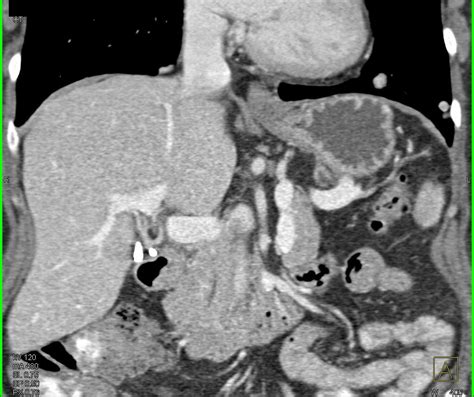 Metastatic Renal Cell Carcinoma With Lung Metastases Chest Case