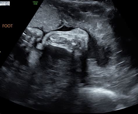 Post Your Ultrasounds Here Page 6 — The Bump