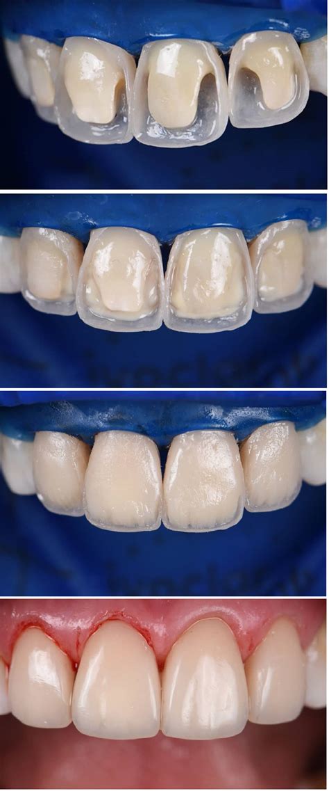 Aesthetic Composite Build Ups In The Anterior Region Dental Surgery