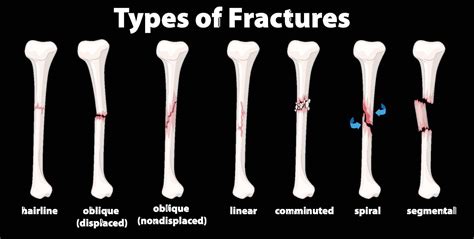 Bone Fractures Types Symptoms Treatment 49 Off