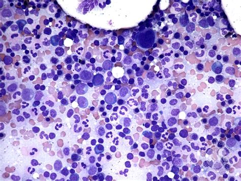 The national marrow donor program (nmdp) is a nonprofit organization founded in 1986 and based in minneapolis, minnesota, that operates the be the match registry of volunteer hematopoietic cell donors and umbilical cord blood units in the united states. Normal pediatric bone marrow aspirate - 1.
