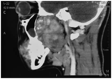 Sagittal Computed Tomography Ct Scan Revealing A Soft Tissue Mass In