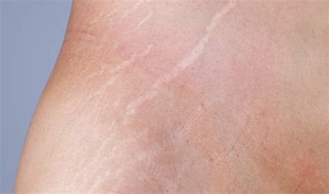 Dmks Scarring Treatment In Australia And New Zealand Dmk Skin