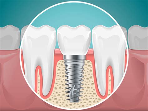Dental Implants Wv • Mountain State Oral And Facial Surgery