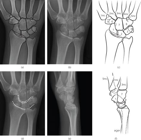 Hand And Wrist Radiology Key