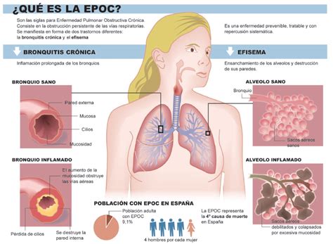 La Bronquitis Escuelapedia Recursos EducativosEscuelapedia