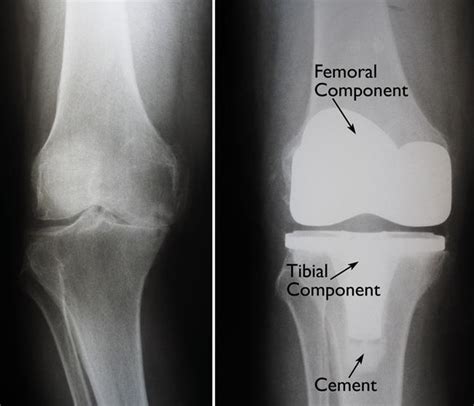 Total Knee Replacement Tkr Dr Mukhis Raj Hospital