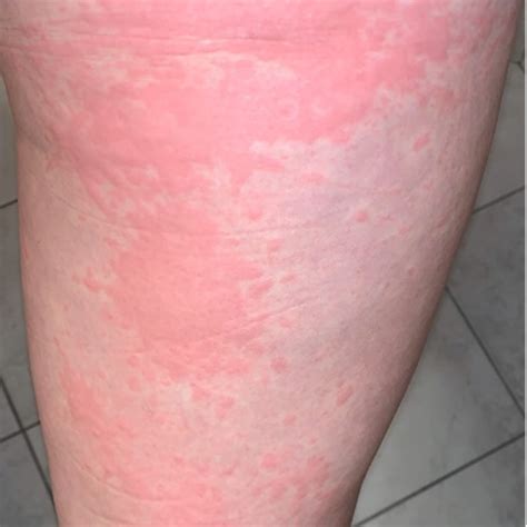 Cutaneous Manifestations Associated With COVID