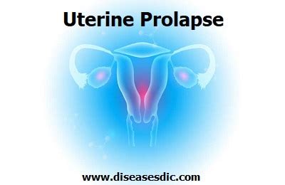 Uterine Prolapse Symptoms Complications And Prevention