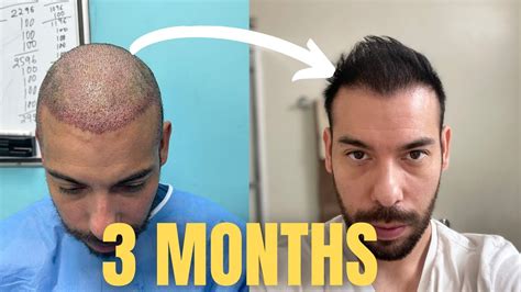 3 Month Hair Transplant Update 4 000 Grafts FUE 9k Total YouTube