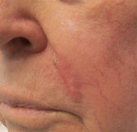 Mohs Surgery Photos Before And After Adc Derm