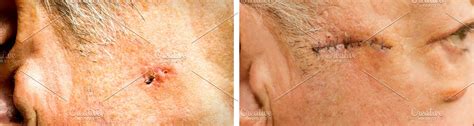 Carcinoma Before And After Surgery Stock Photo Containing Basal And