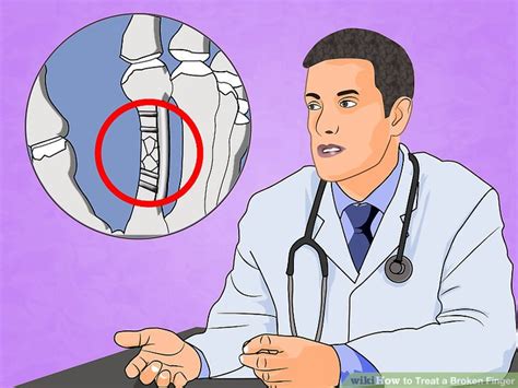 Expert Advice On How To Treat A Broken Finger Wikihow