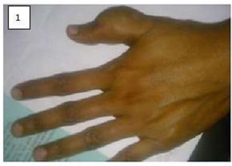 Figure 1 From Fibro Osseous Pseudo Tumor Of Digits Of Small Bones A